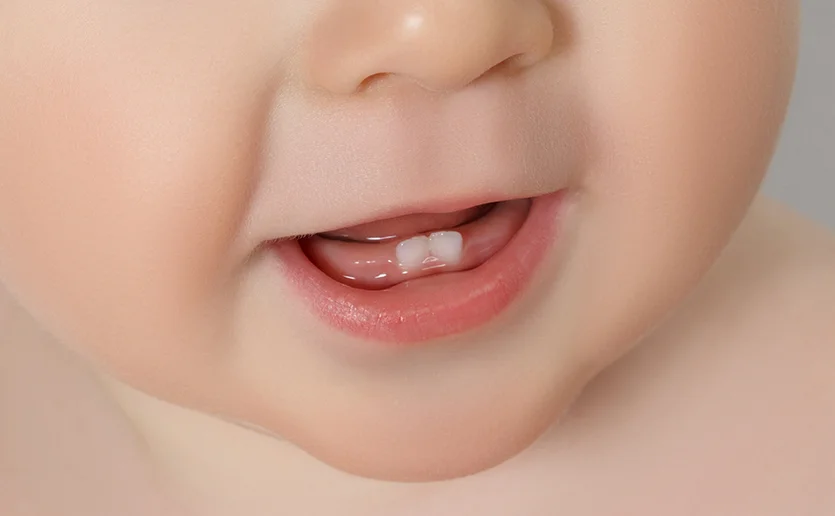 How to Fix Pacifier Teeth? 2 Methods That Work · Livera Dental Clinic Florya Istanbul