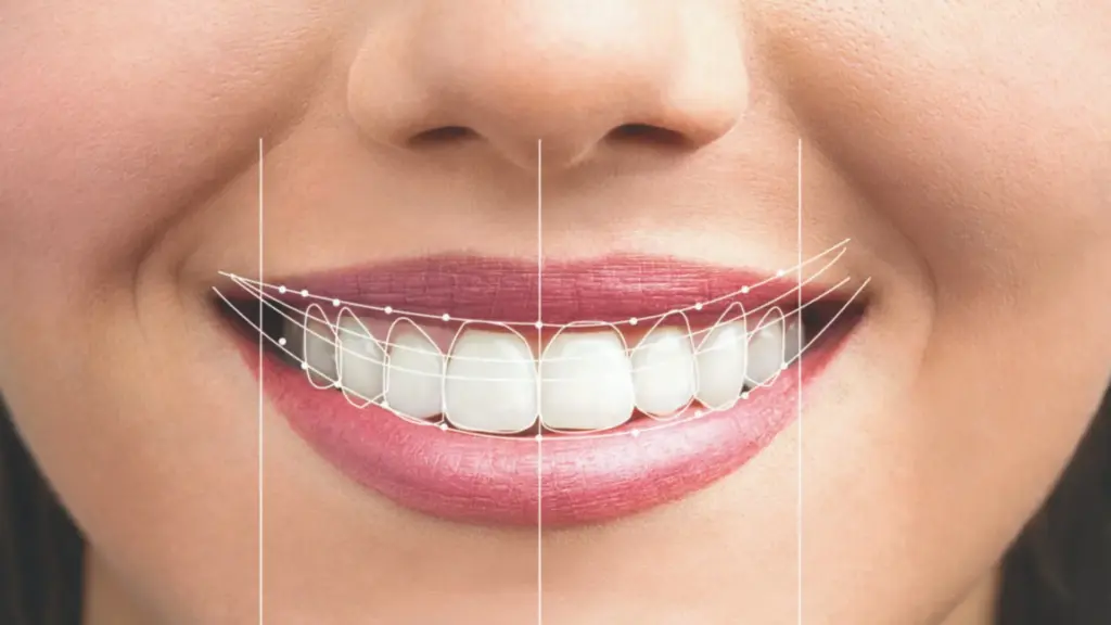 Hollywood Smile Design Procedure in Turkey · Livera Dental Clinic Florya Istanbul