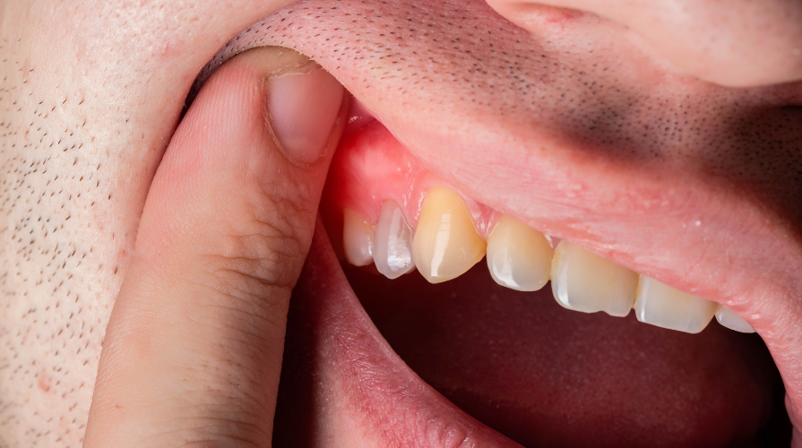 What is a dental abscess, and how does it go away? · Livera Dental Clinic Florya Istanbul
