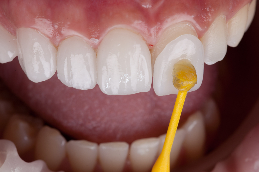 Why Are Veneers More Affordable in Turkey? · Livera Dental Clinic Florya Istanbul