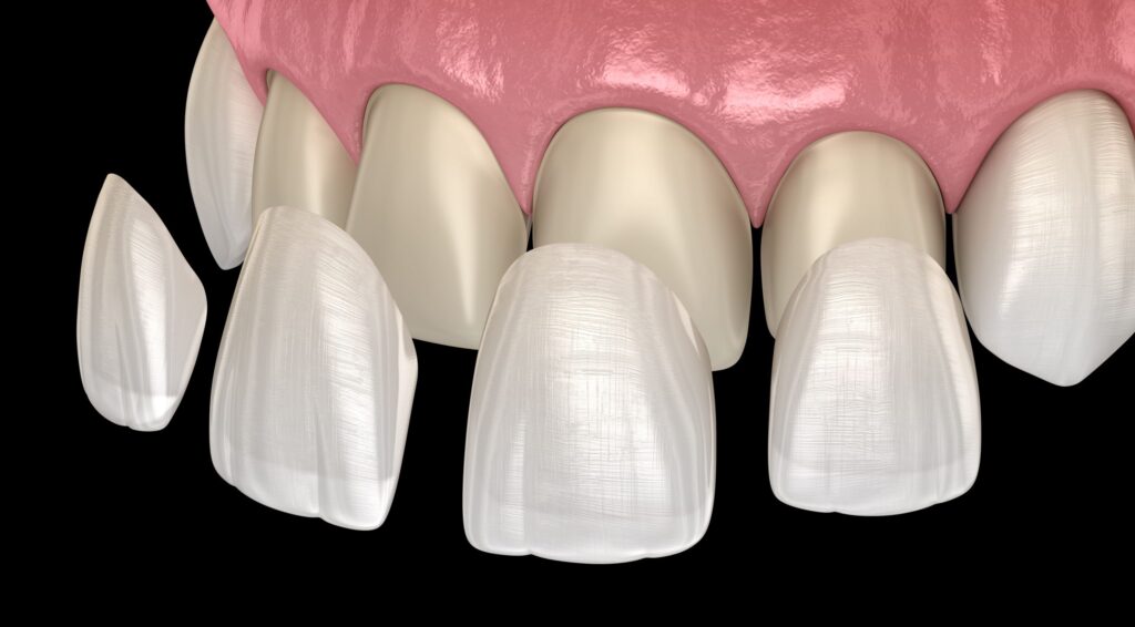 Что такое фарфоровые виниры и как они изготавливаются? · Livera Dental Clinic Флория Стамбул