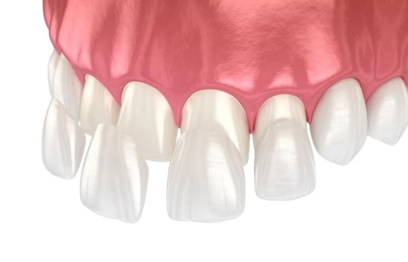Dental Veneers: 3 Different Types and Their Costs · Livera Dental Clinic Florya Istanbul