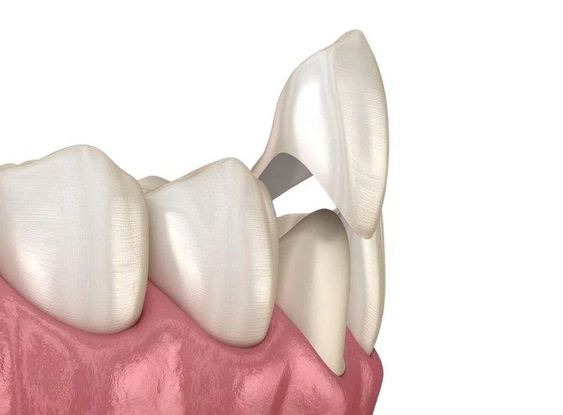 Are Veneers Permanent? How Long Do They Last? · Livera Dental Clinic Florya Istanbul
