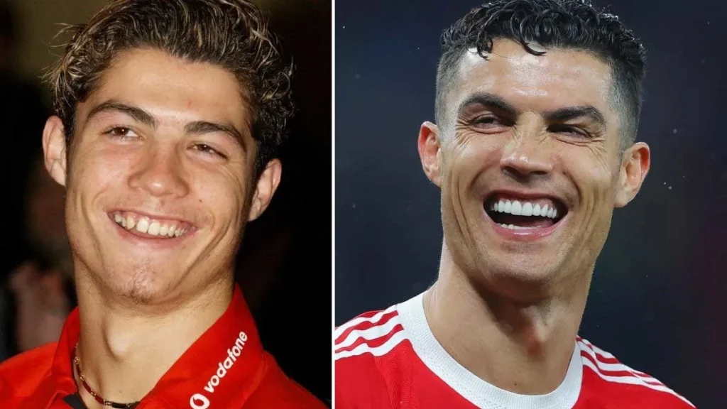 Ronaldo Teeth - Hollywood Smile · Livera Dental Clinic Florya Istanbul