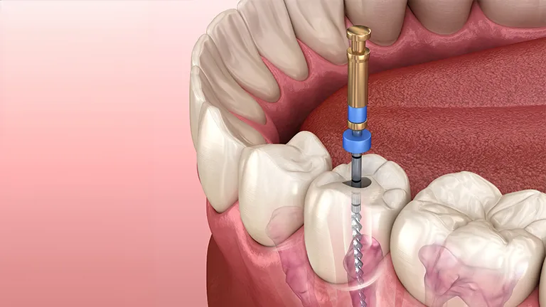 How to Identify Failed Root Canal Treatment and What Are the Consequences? · Livera Dental Clinic Florya Istanbul