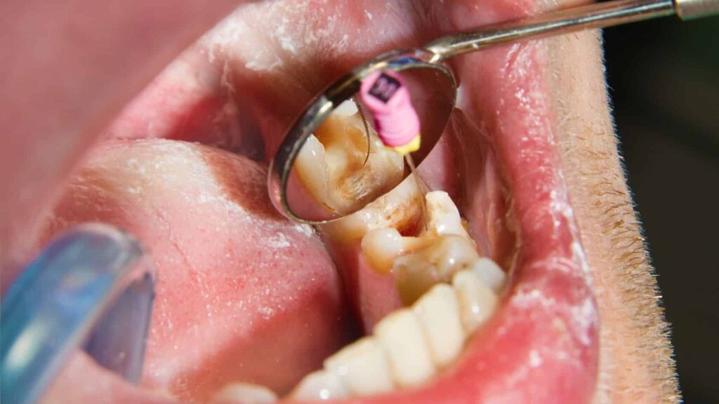 Kanal Tedavisi mi yoksa Diş Çekimi mi? Karar Vermeyi Kolaylaştıran Bilimsel Bir Bakış · Livera Dental Clinic Florya İstanbul