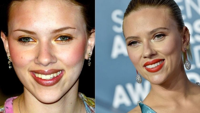 Scarlett Johansson Dişleri: Bir Yıldızın Efsanevi Gülümsemesinin Arkasındaki Sırlar · Livera Dental Clinic Florya İstanbul