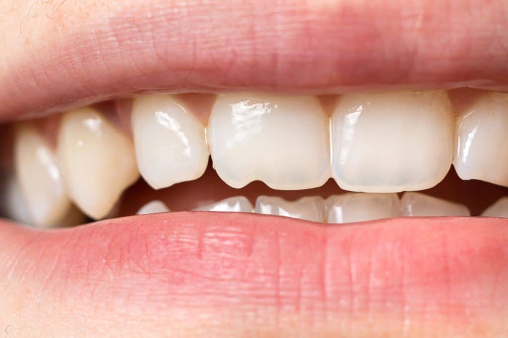 Cracked Teeth: What Are They, Why Do They Occur, and How Are They Treated? · Livera Dental Clinic Florya Istanbul