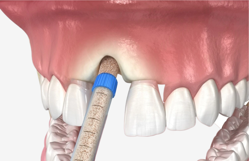 Diş İmplantı İçin Sinüs Grefti Gerekiyor mu? · Livera Dental Clinic Florya İstanbul