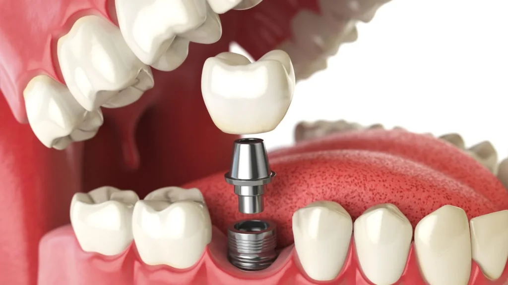 Straumann Implants from A to Z · Livera Dental Clinic Florya Istanbul