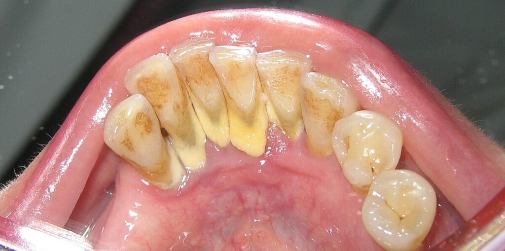Diş taşı temizliğinden sonra nelere dikkat edilmelidir? · Livera Dental Clinic Florya İstanbul