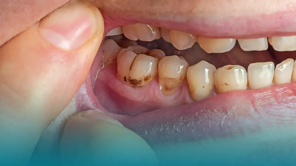 Dental Tartar Removal: Procedure Steps, Methods, and Cost Factors · Livera Dental Clinic Florya Istanbul