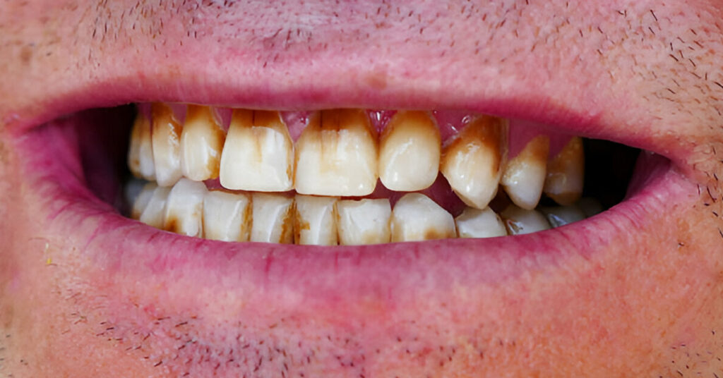 Diş taşı temizliğinden sonra nelere dikkat edilmelidir? · Livera Dental Clinic Florya İstanbul