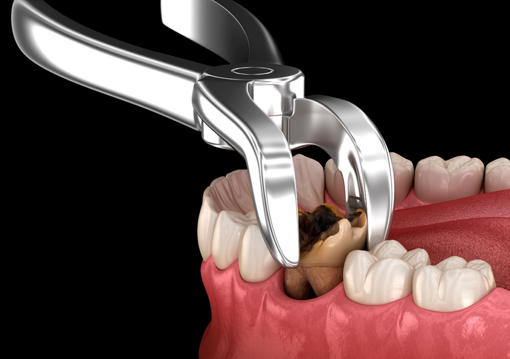 What Can You Do After a Tooth Extraction? · Livera Dental Clinic Florya Istanbul