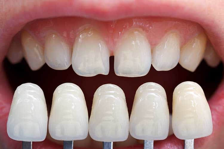 Diş Törpüleme Nedir ve Kimler Bu İşleme İhtiyaç Duyar? · Livera Dental Clinic Florya İstanbul