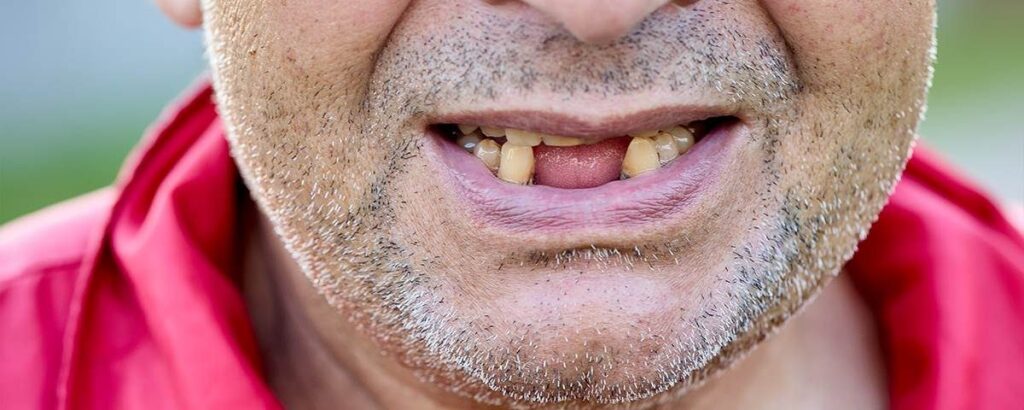 What Causes Tooth Loss and How Can It Be Prevented? · Livera Dental Clinic Florya Istanbul