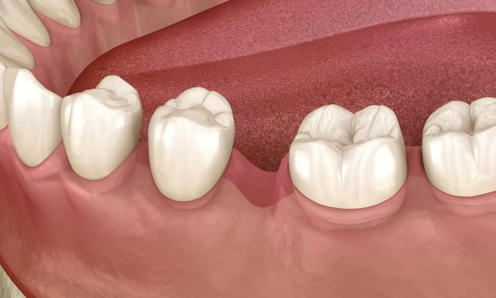 Diş Kaymasının Belirtileri ve Nasıl Düzeltilir · Livera Dental Clinic Florya İstanbul
