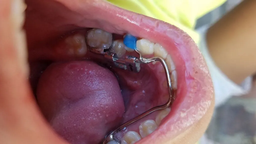 Diş Aralayıcısı Dişlere Ne Yapar? · Livera Dental Clinic Florya İstanbul
