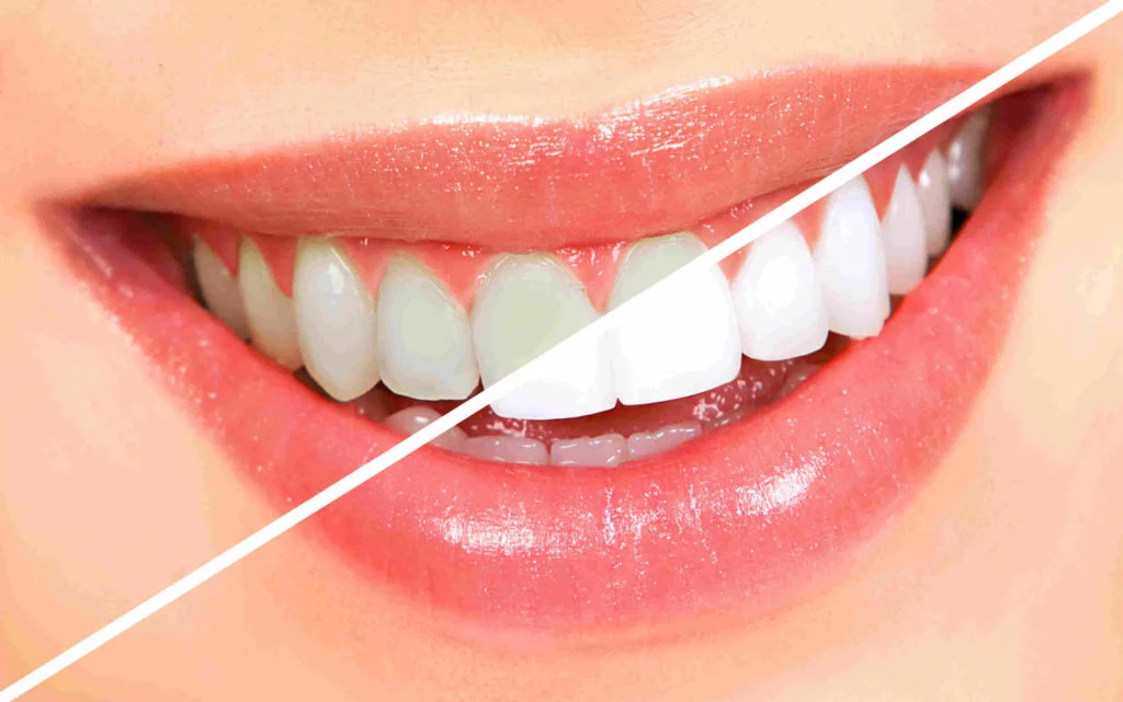 Is Laser Teeth Whitening Safe? · Livera Dental Clinic Florya Istanbul