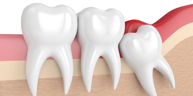 Teeth What Happens if a Tooth That Needs Extraction Is Not Removed? · Livera Dental Clinic Florya Istanbul
