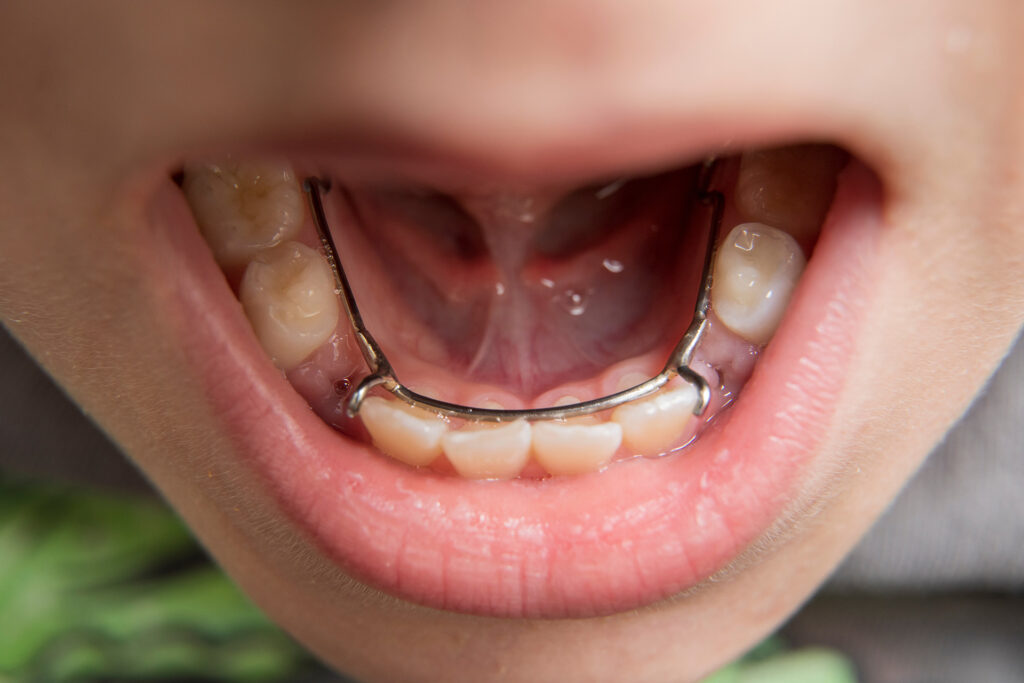 Diş Aralayıcısı Dişlere Ne Yapar? · Livera Dental Clinic Florya İstanbul