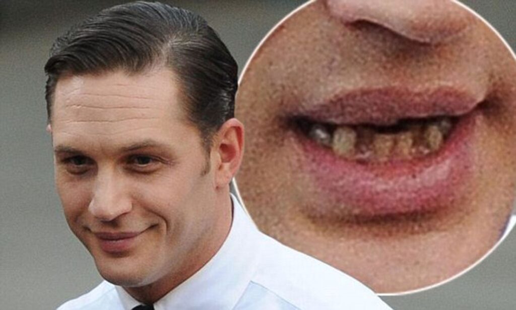 The Evolution of Tom Hardy Teeth: From Rugged to Refined · Livera Dental Clinic Florya Istanbul