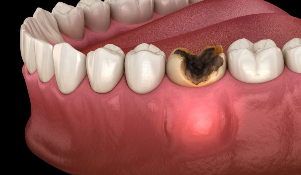 What is a Tooth Abscess and How Does it Go Away? · Livera Dental Clinic Florya Istanbul