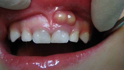 What is a dental abscess, and how does it go away? · Livera Dental Clinic Florya Istanbul
