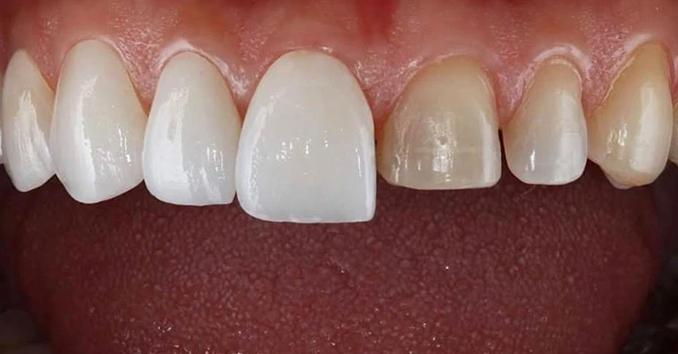 Diş Kesimi Sonrası Nelere Dikkat Edilmeli? · Livera Dental Clinic Florya İstanbul