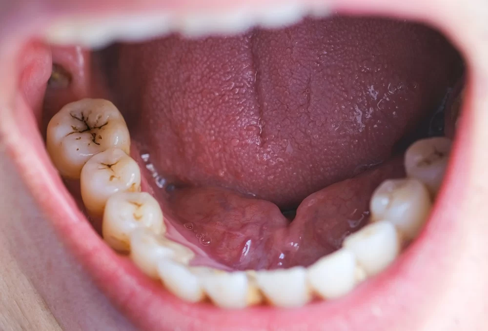 What Helps Relieve Tooth Decay Pain? · Livera Dental Clinic Florya Istanbul