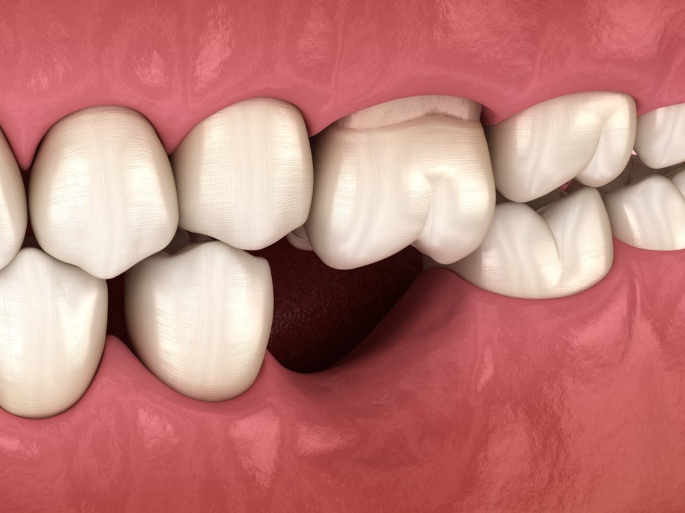4 Causes of Tooth Loss and Ways to Understand Prevention · Livera Dental Clinic Florya Istanbul