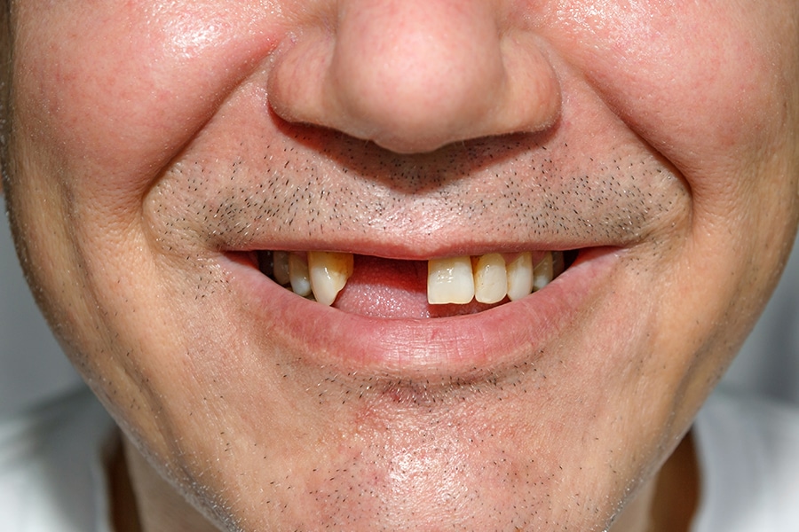 What Causes Tooth Loss and How Can It Be Prevented? · Livera Dental Clinic Florya Istanbul
