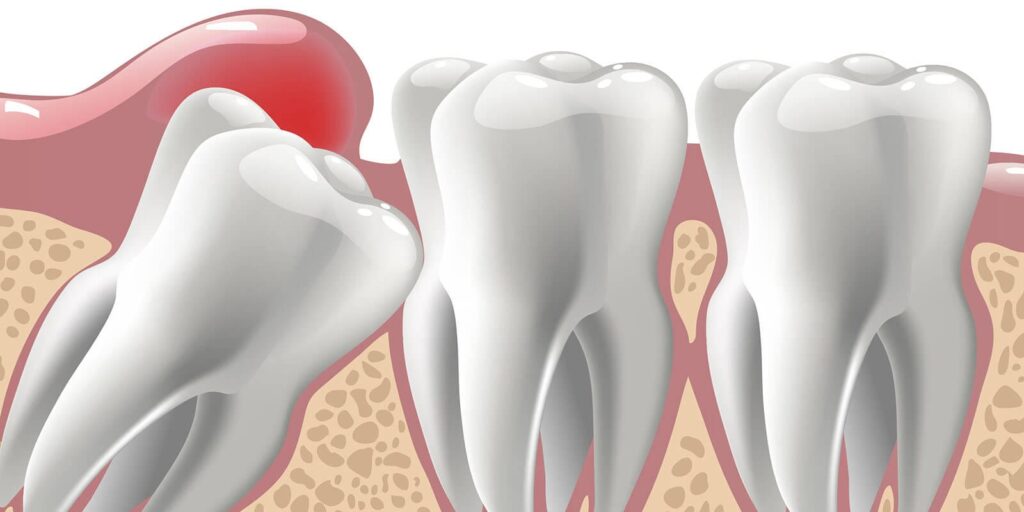 What Happens if a Tooth That Needs Extraction Is Not Removed? · Livera Dental Clinic Florya Istanbul