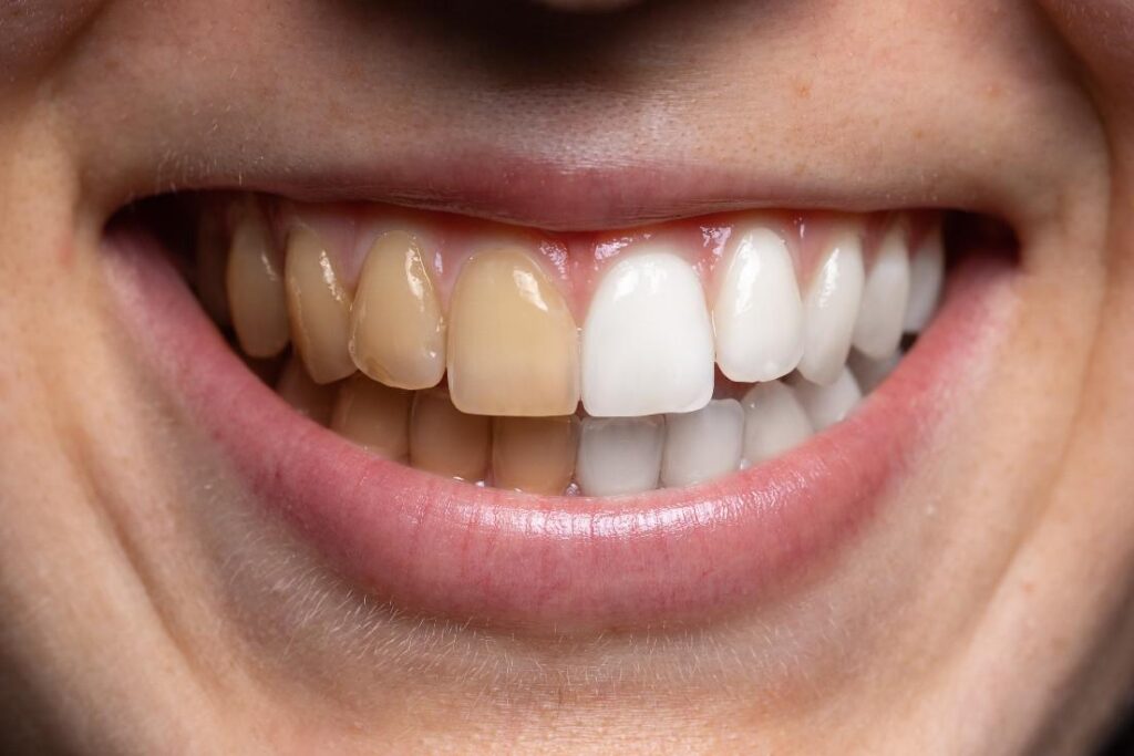 How to Remove Tooth Stains With Natural Products? · Livera Dental Clinic Florya Istanbul