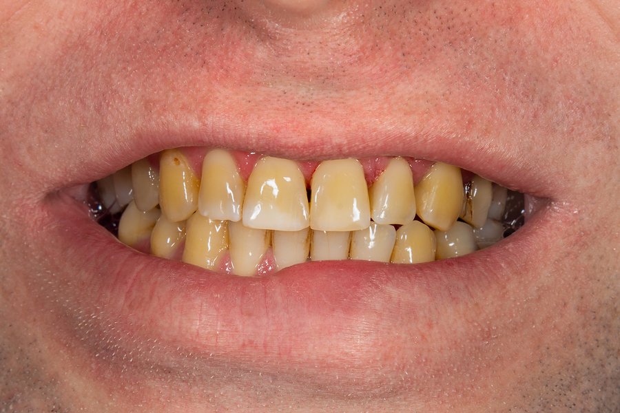How to Remove Tooth Stains With Natural Products? · Livera Dental Clinic Florya Istanbul