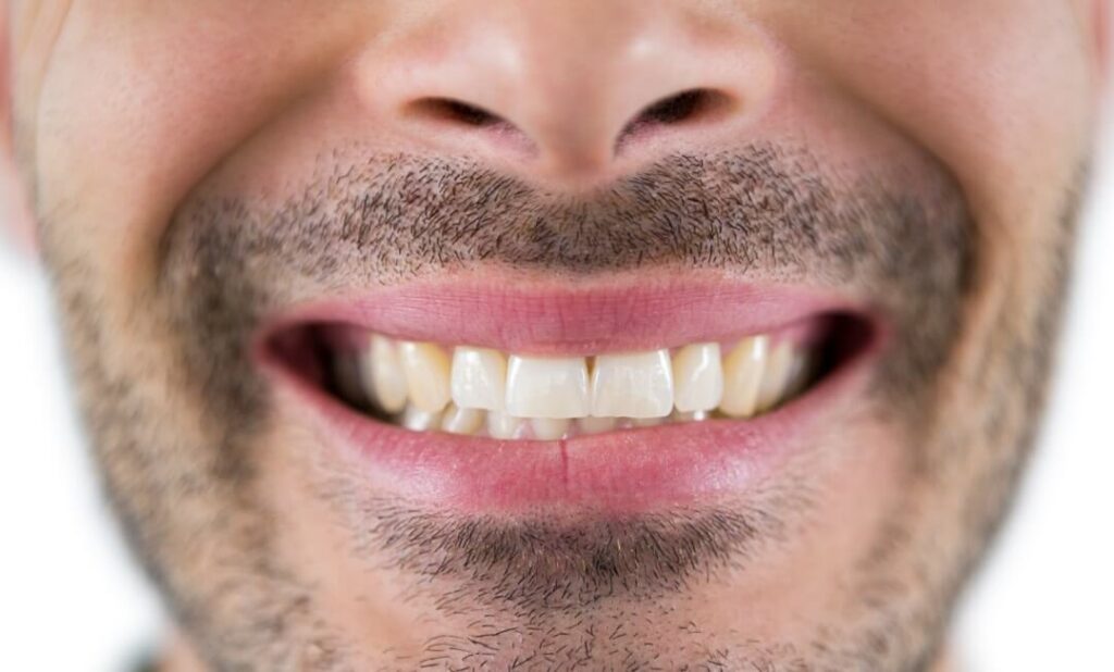 How to Detect Tooth Transparency and 3 Different Treatment Methods · Livera Dental Clinic Florya Istanbul