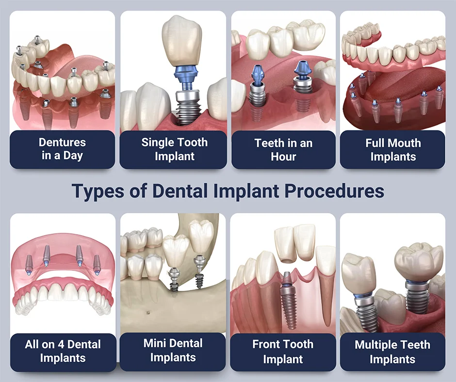 Different Types of Dental Implants: Their Advantages and Disadvantages · Livera Dental Clinic Florya Istanbul