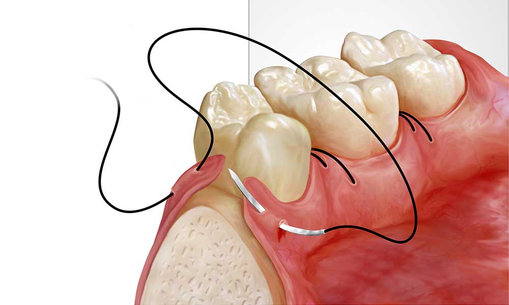 What is Alveoloplasty? How is it Performed and Post-Care? · Livera Dental Clinic Florya Istanbul