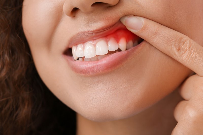 Воспаление дёсен: симптомы и методы лечения · Livera Dental Clinic Флория Стамбул
