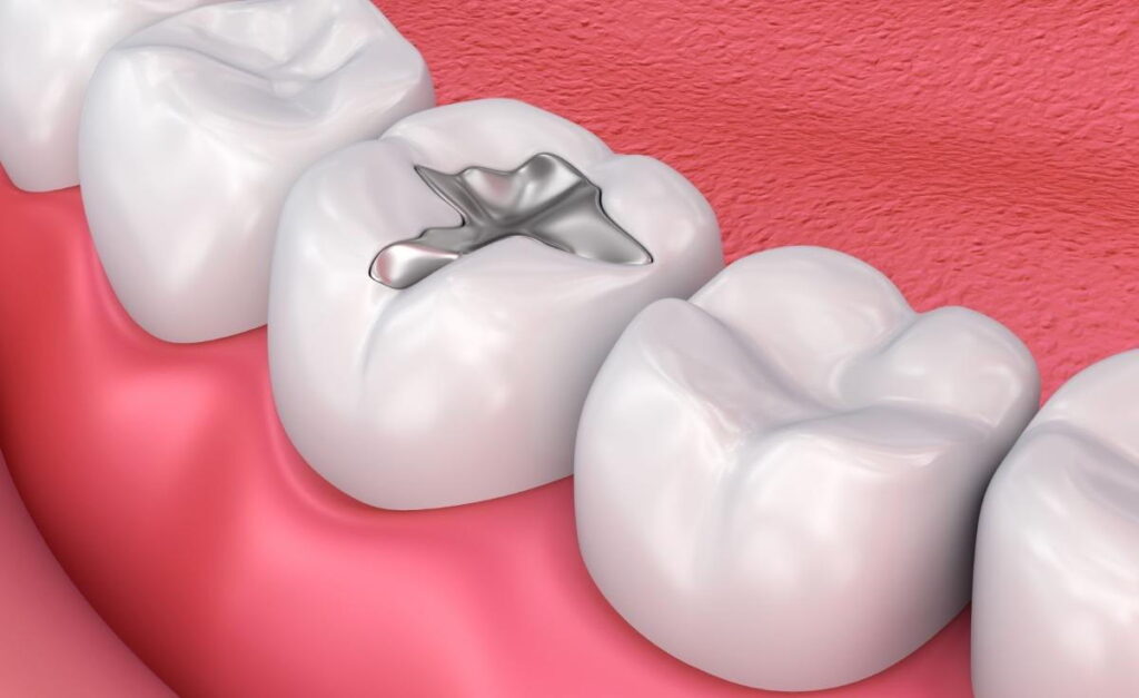Can You Be Allergic to Dental Fillings? · Livera Dental Clinic Florya Istanbul