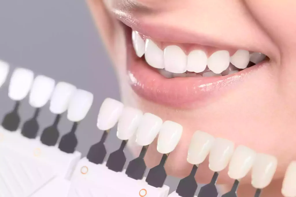 How is a Veneer Applied Without Filing Down the Teeth? · Livera Dental Clinic Florya Istanbul