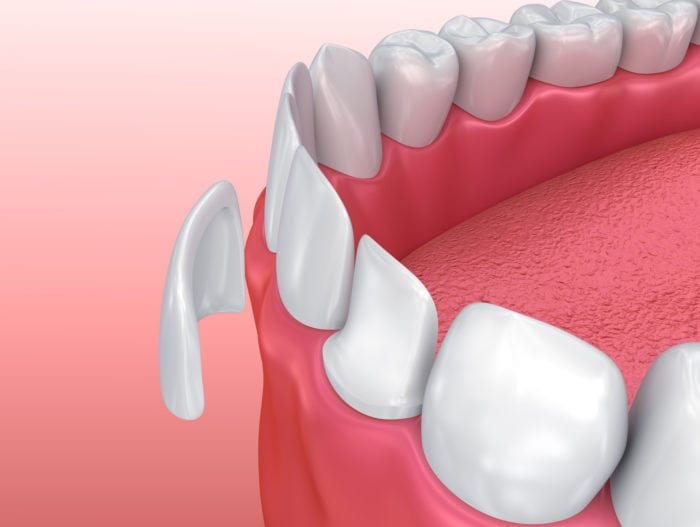 How is a Veneer Applied Without Filing Down the Teeth? · Livera Dental Clinic Florya Istanbul