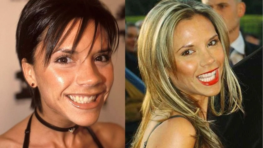 6 Celebrities Who Got Porcelain Veneers: Their Smile Transformations · Livera Dental Clinic Florya Istanbul