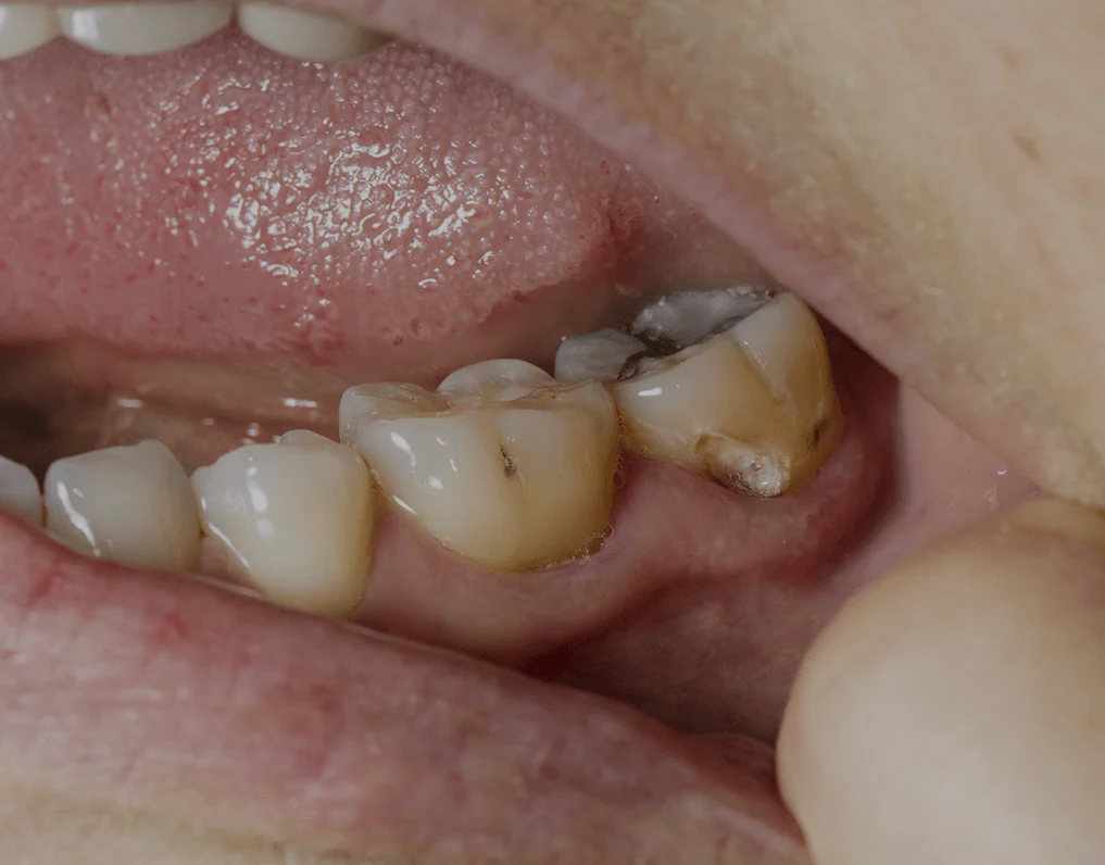 How to Save a Dead Tooth? Causes, Symptoms, and Prevention Methods · Livera Dental Clinic Florya Istanbul