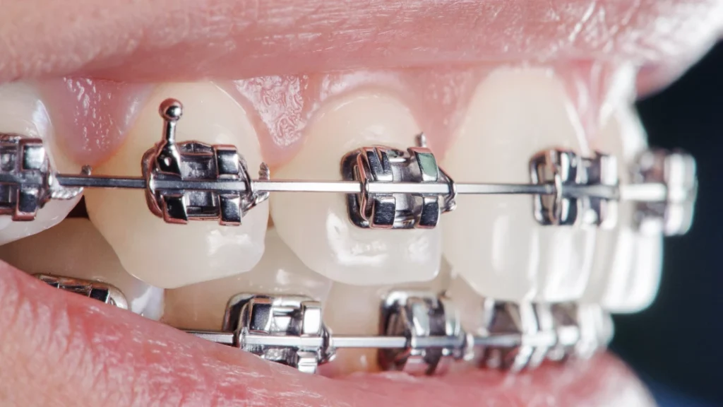 What is a Bracket? Types and Varieties · Livera Dental Clinic Florya Istanbul