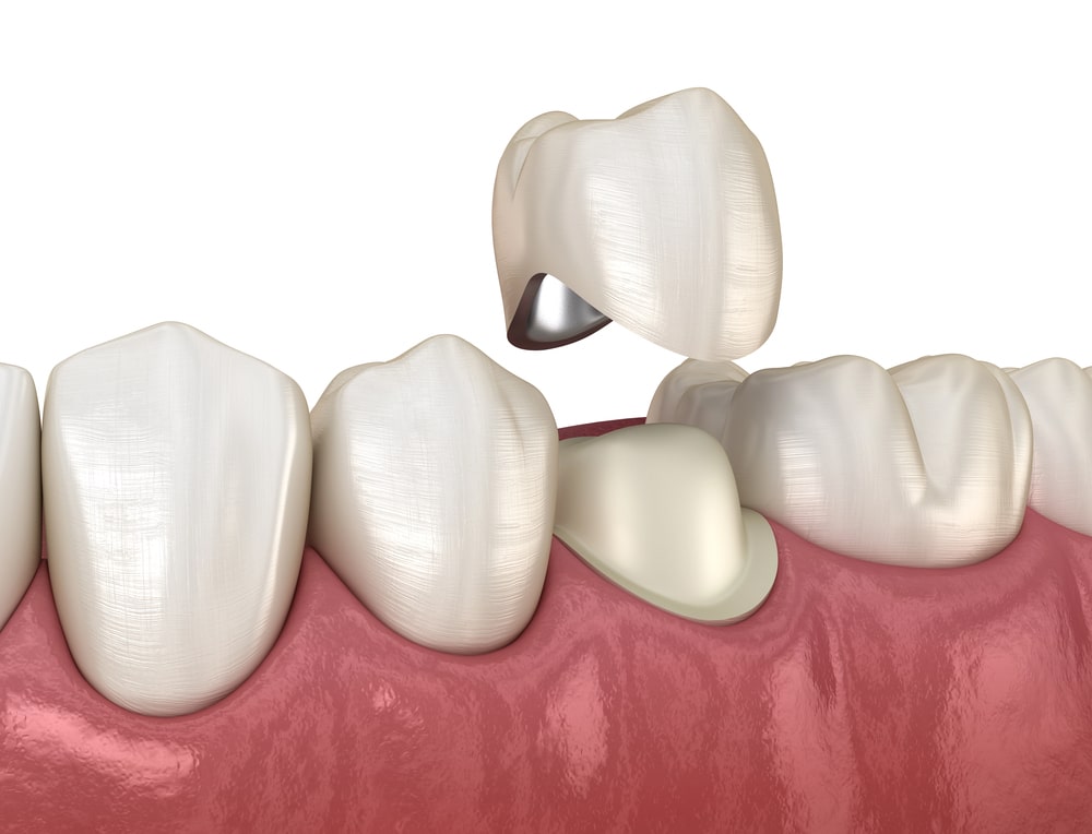 CEREC Crown: Everything About the Technology · Livera Dental Clinic Florya Istanbul