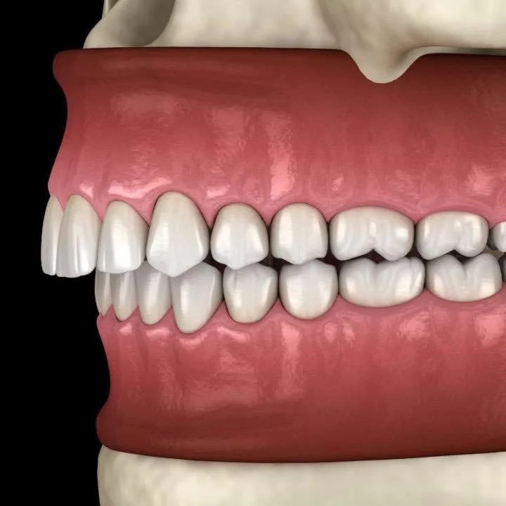 Derin Isırık Nedir ve Nasıl Tedavi Edilir? · Livera Dental Clinic Florya İstanbul
