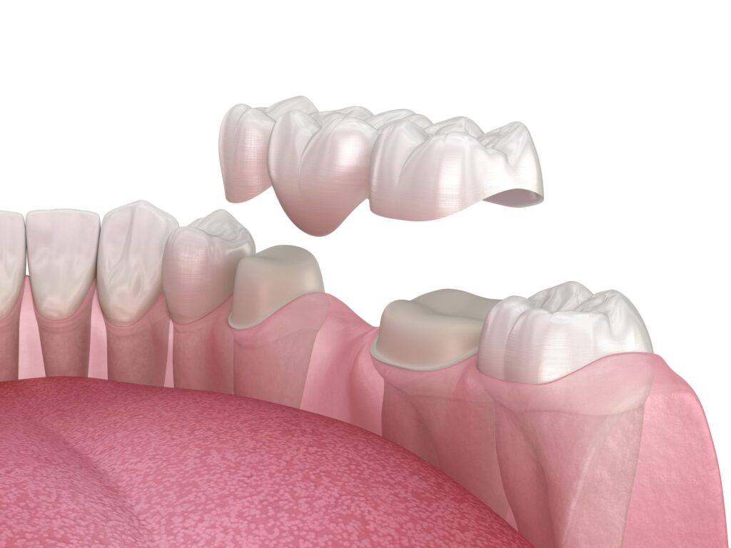 Diş Köprüsü Nedir? Türleri, Faydaları ve Uygulama Süreci · Livera Dental Clinic Florya İstanbul