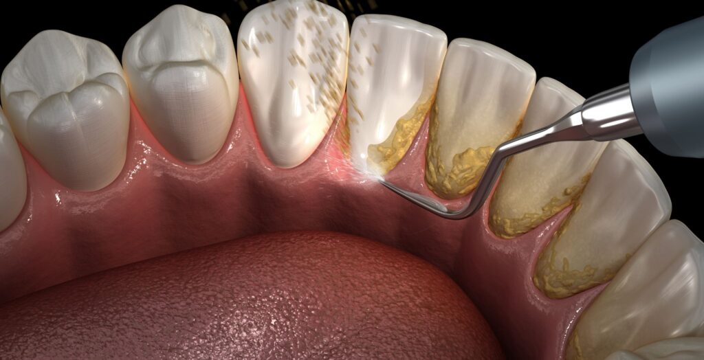 How to Remove Dental Plaque? Important Tips for Healthier Teeth · Livera Dental Clinic Florya Istanbul