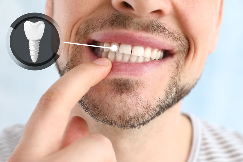 Dental Posts: Types, Application Process, and Benefits · Livera Dental Clinic Florya Istanbul
